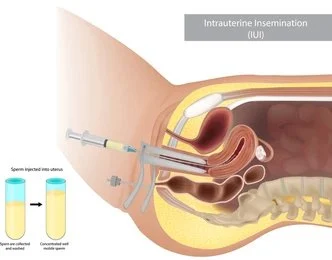 IUI Treatment in Pune